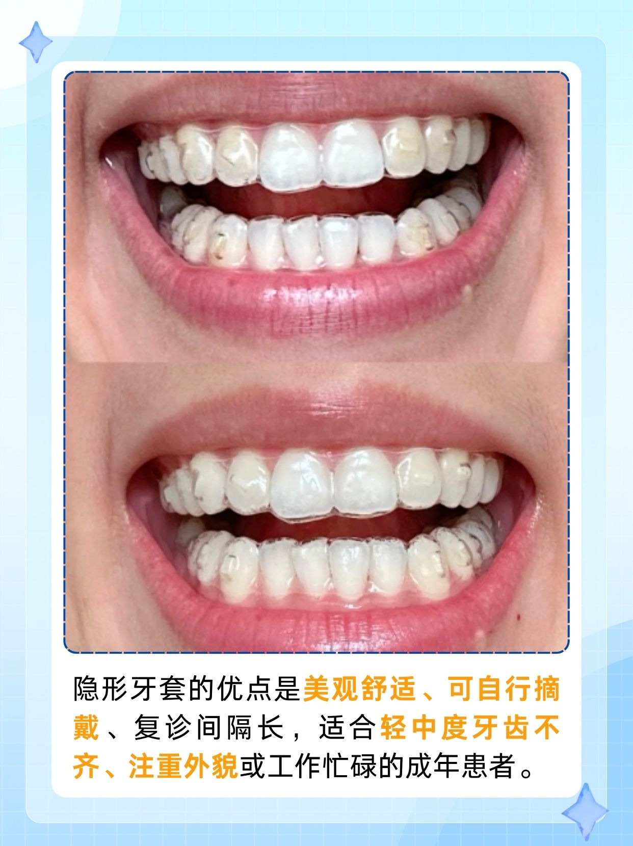 隐形牙套几天换一副，你了解吗？