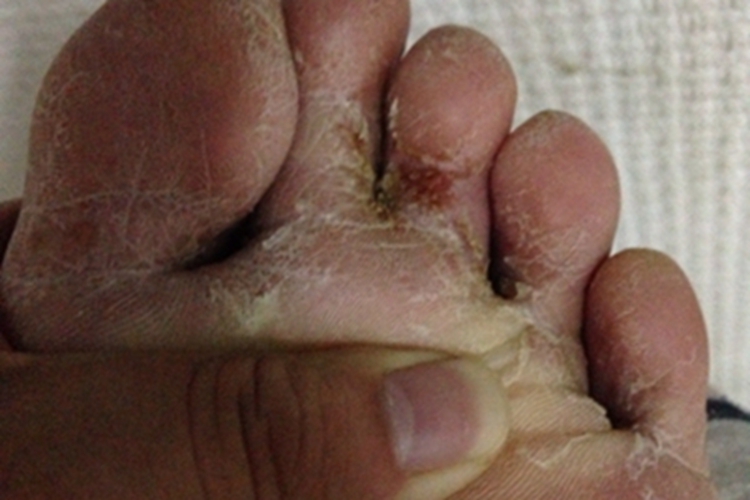 糜烂型足癣脚趾脱皮溃烂图