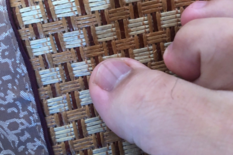 甲母痣脚趾甲上有竖纹图 甲母痣脚趾甲上有竖纹图