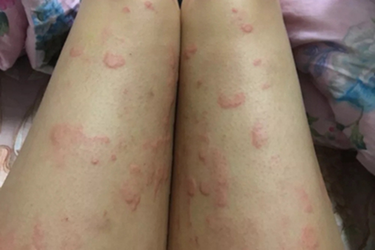 昆虫性皮炎大腿大红疙瘩图