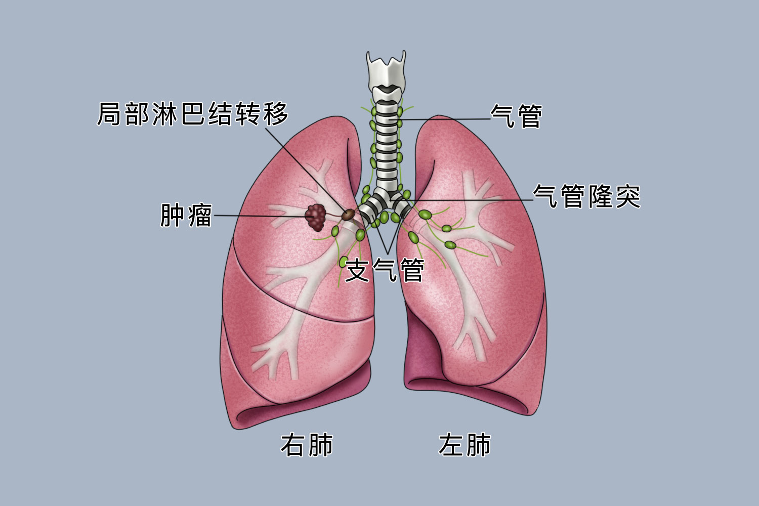 肺腺癌转移对比图
