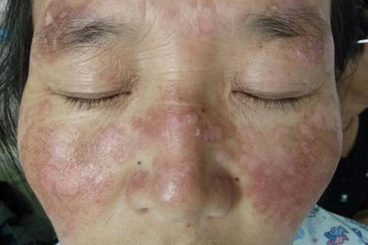 系统性红斑狼疮图 系统性红斑狼疮图