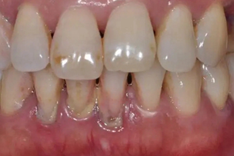 慢性牙周炎下牙龈萎缩图