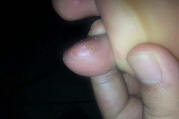 脚趾长水疱有小黄点图