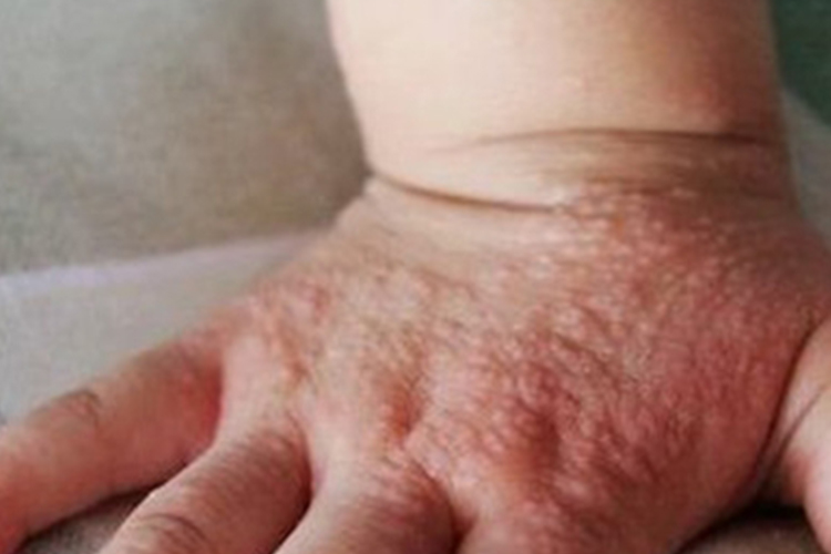 摩擦性苔藓样疹手上起小疙瘩图