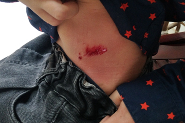 跌伤腰部血痂图