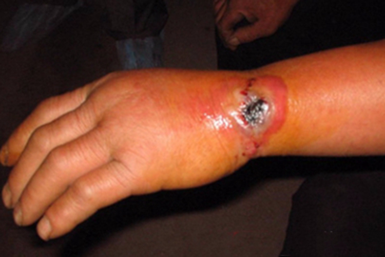 皮肤炭疽手腕大坑图 皮肤炭疽手腕大坑图