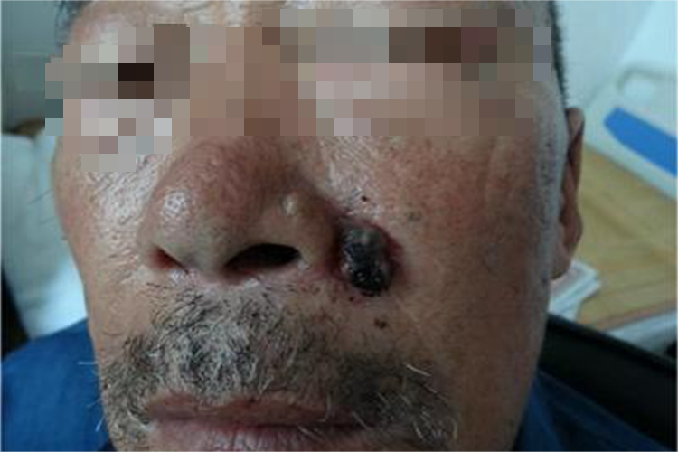 结节型黑色素瘤面部大疙瘩图