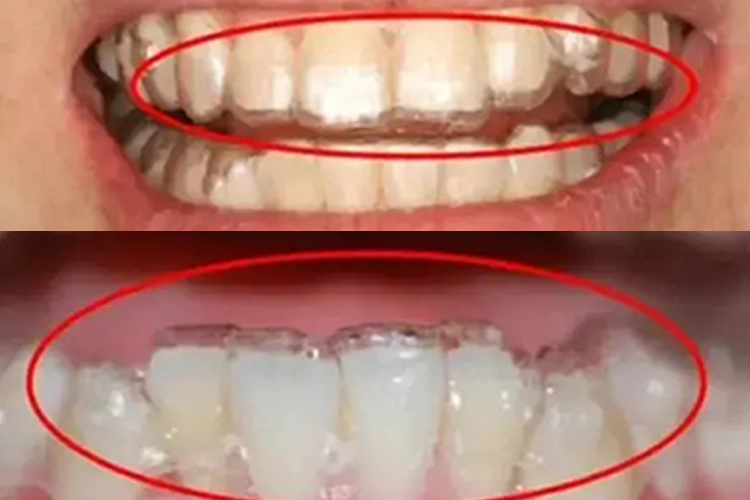 隐形牙套不贴合图