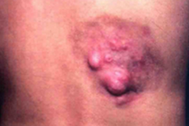 隆突性皮肤纤维肉瘤背部大疙瘩图