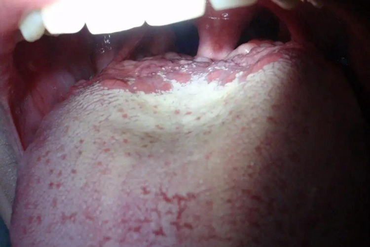 舌甲状腺凸起颗粒图