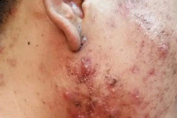 类脂蛋白沉积症面部疙瘩图 类脂蛋白沉积症面部疙瘩图