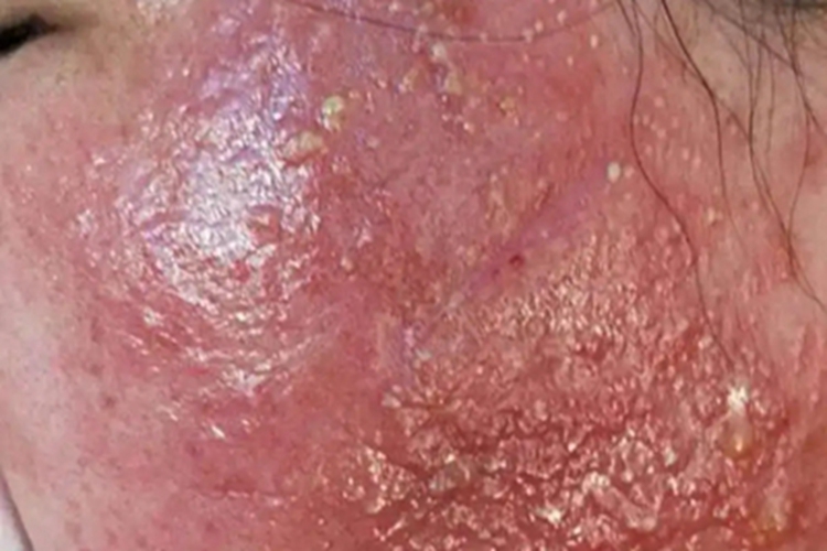 糖皮质激素依赖性皮炎脓包图