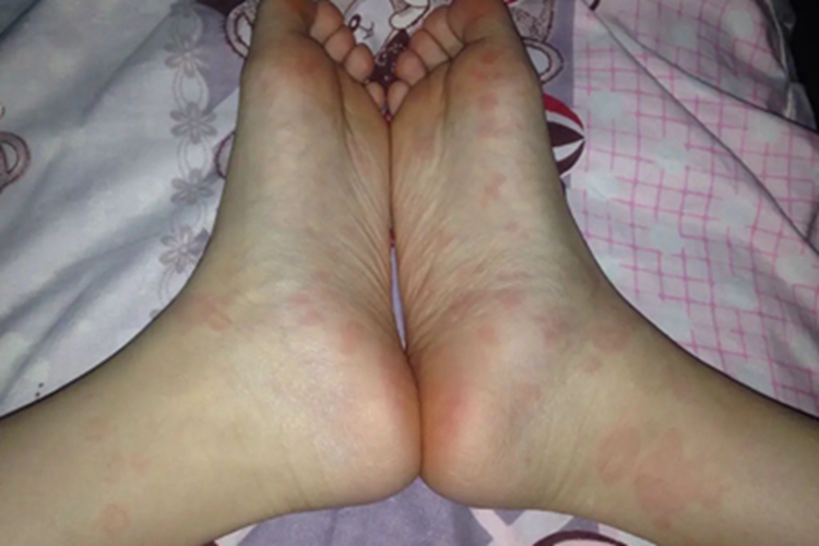 更年期角皮症脚底红斑图