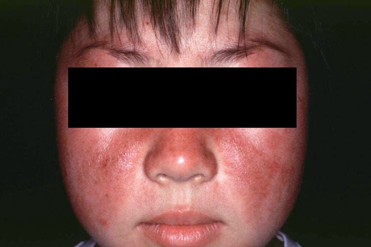 系统性红斑狼疮图 系统性红斑狼疮图