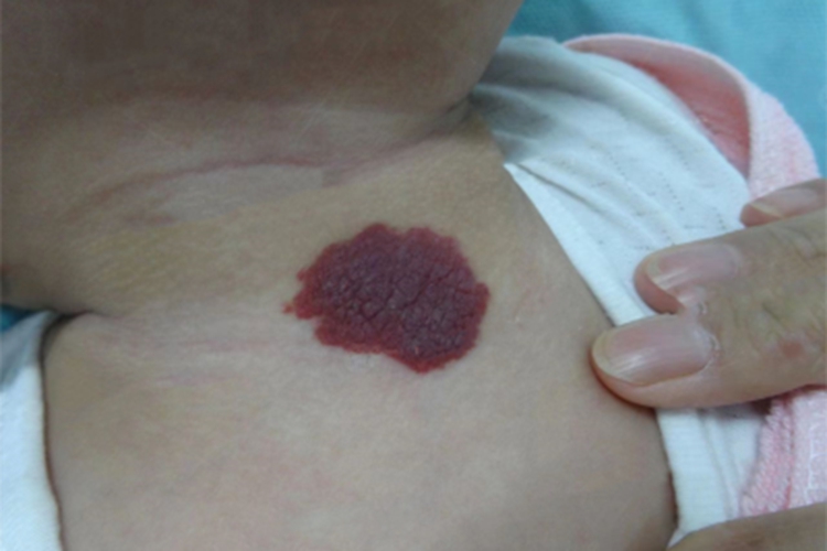 蔓状血管瘤前胸红斑图
