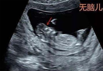 开放性神经管缺陷无脑儿图