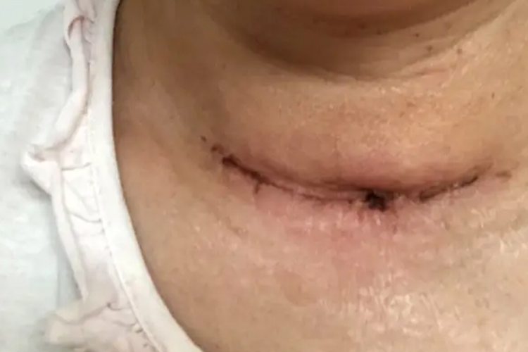 甲状腺术后伤口红肿鼓包图