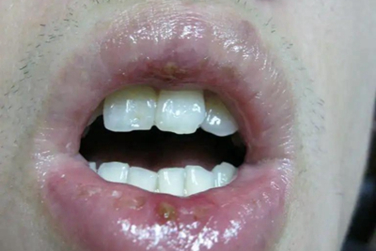 白塞病嘴唇溃疡有结痂图