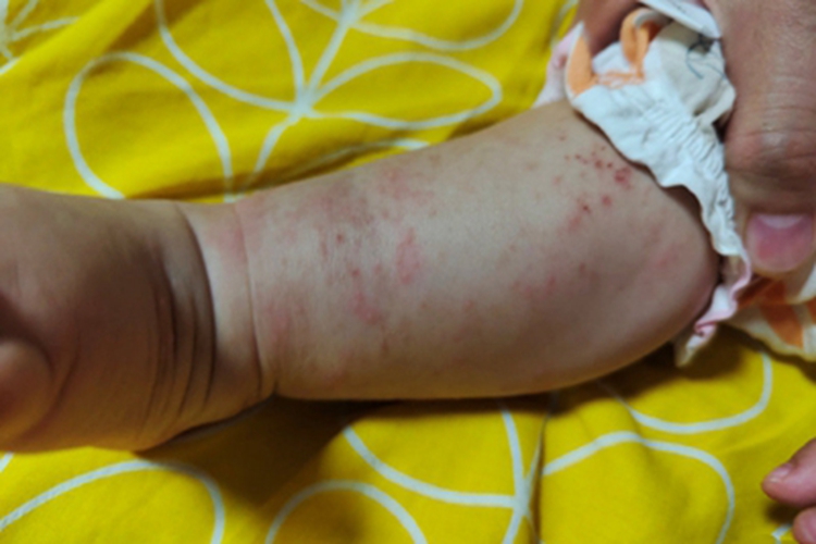 急性湿疹小腿小疙瘩图