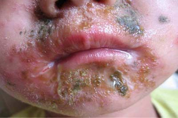 脓疱病口周裂纹图