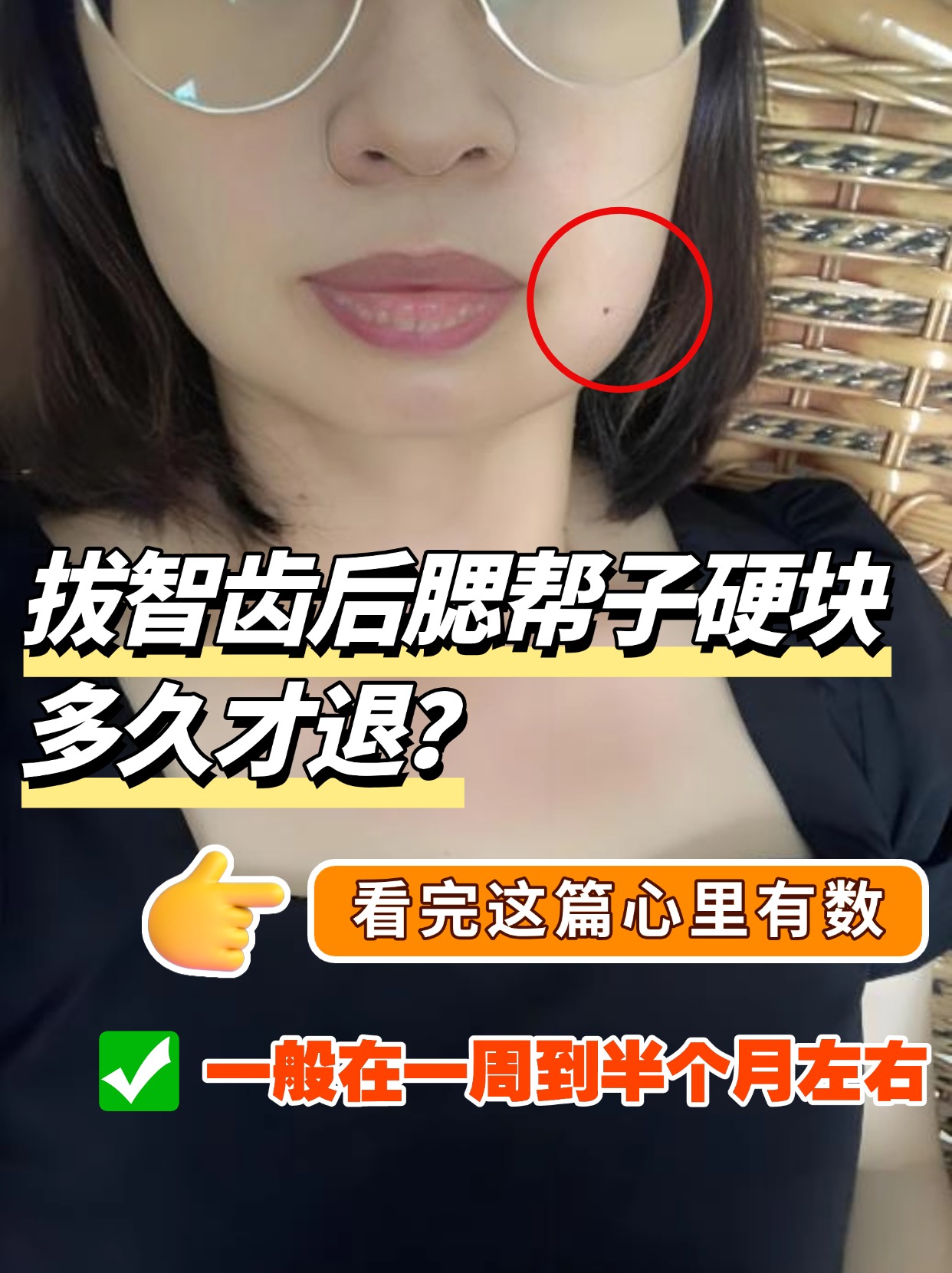 拔智齿后腮帮子硬块多久才退？看完这篇心里有数