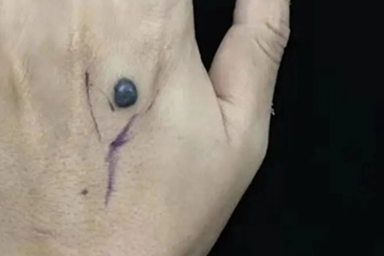 细胞蓝痣手背症状图