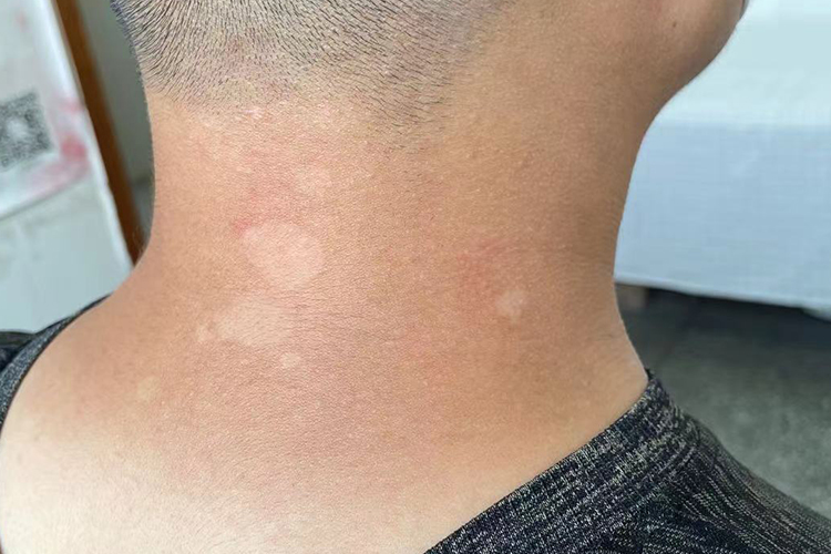 颈部色素减少性花斑癣图