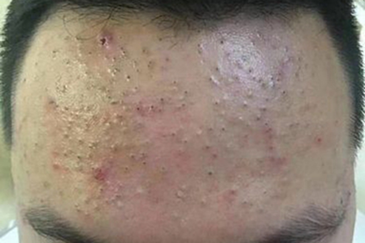 黑头前额症状图