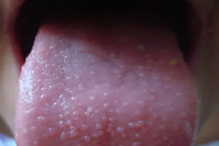 菌状乳头炎图