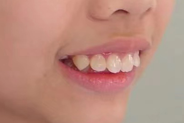 儿童牙齿深覆合图