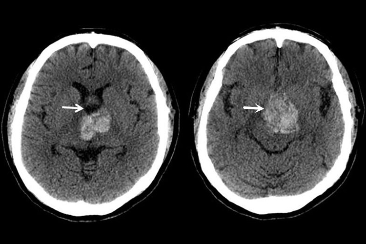 海绵状血管瘤图 海绵状血管瘤图