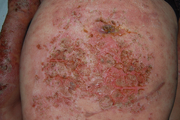 急性湿疹腹部斑图