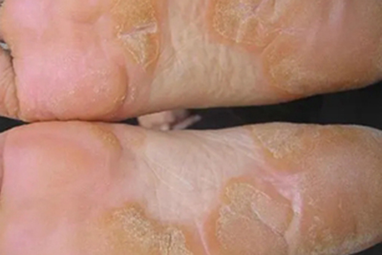 塞扎里综合征脚部斑图 塞扎里综合征脚部斑图