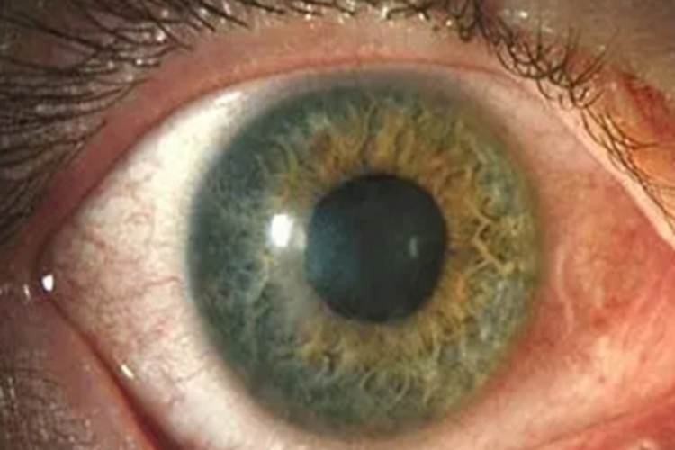 病毒性结膜炎眼角症状图