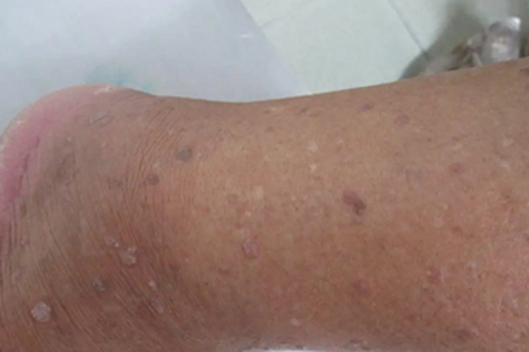 灰泥角化病长斑图