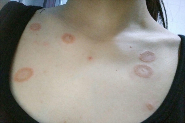 玫瑰糠疹前胸症状图 玫瑰糠疹前胸症状图