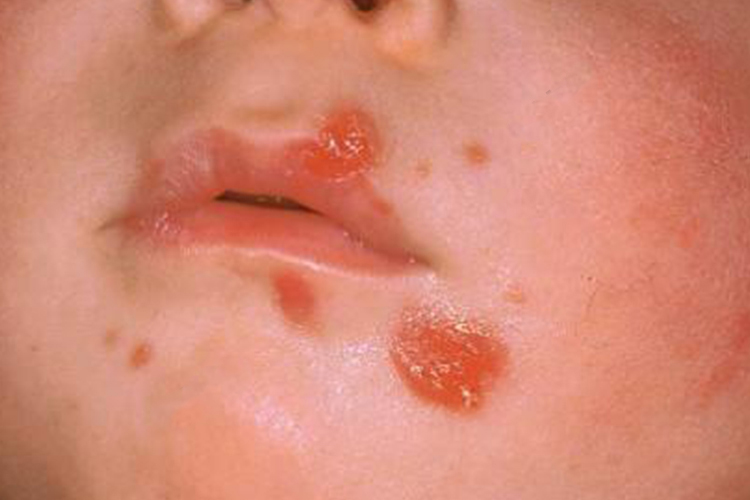 脓疱疮湿润疮面图 脓疱疮湿润疮面图