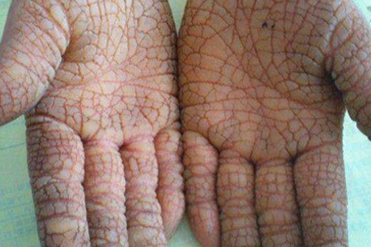 残毁性掌跖角皮症症状图