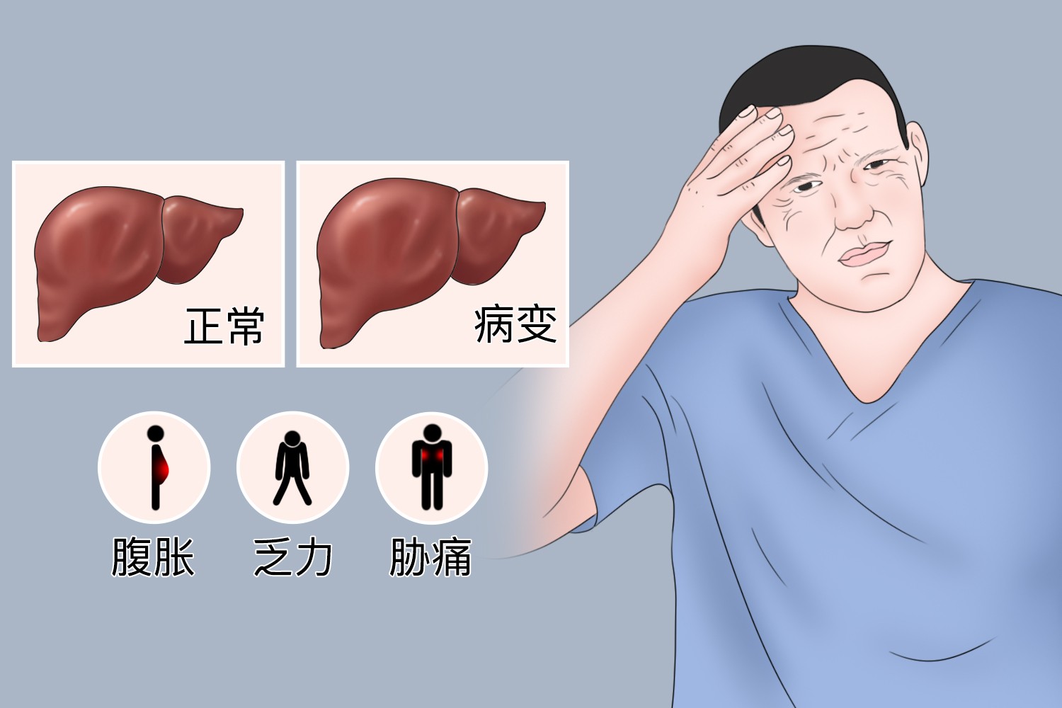 肝肿大的早期症状图 肝肿大的早期症状图