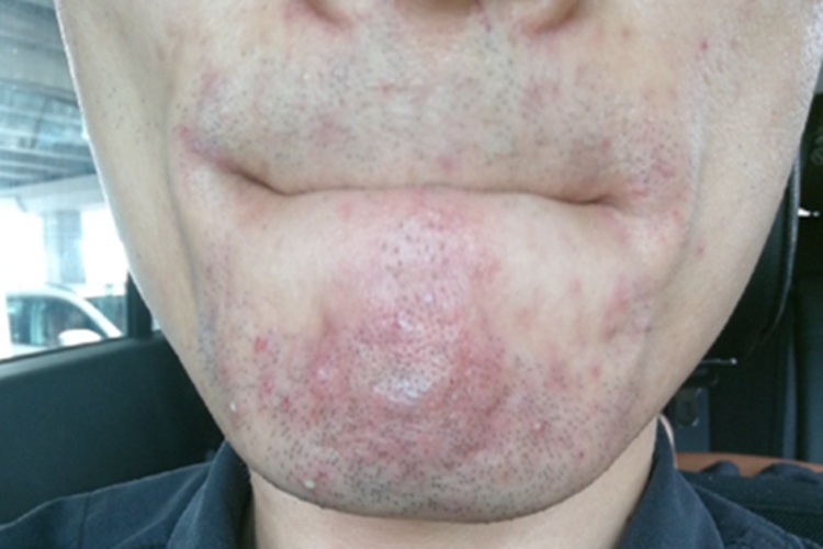 须疮口周丘疹图