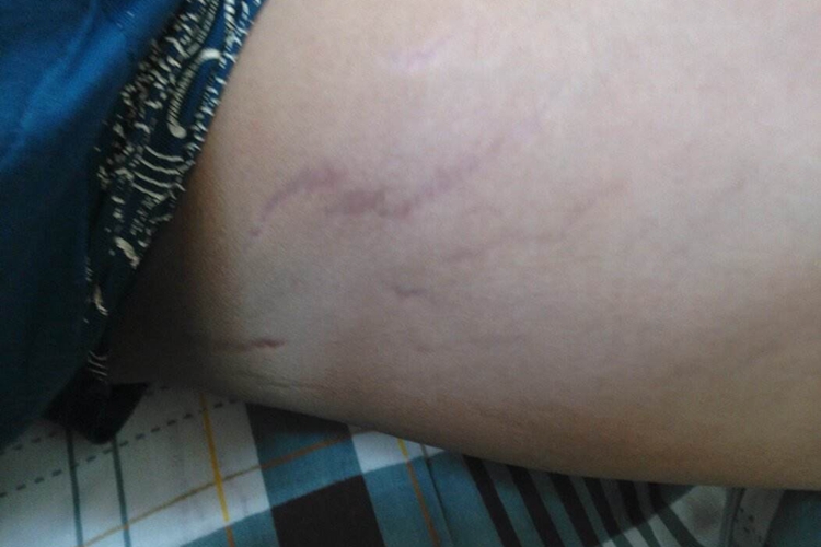 大腿内侧生长纹图