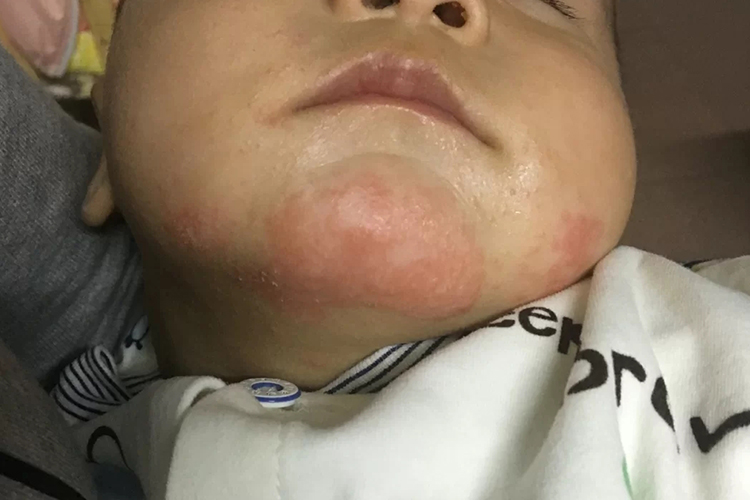 婴儿湿疹宝宝下巴红图 婴儿湿疹宝宝下巴红图