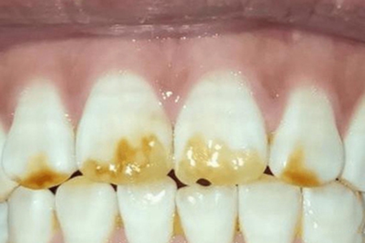牙釉质发育不全牙齿症状图