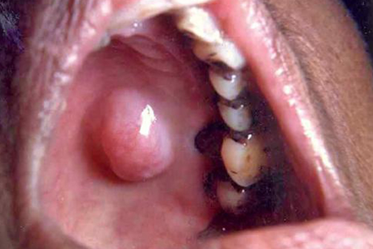 口腔上颚多形性腺瘤图