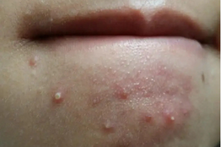 毛囊炎下巴白点图 毛囊炎下巴白点图