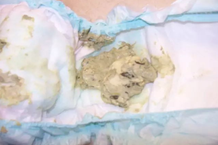 异常白色大便图