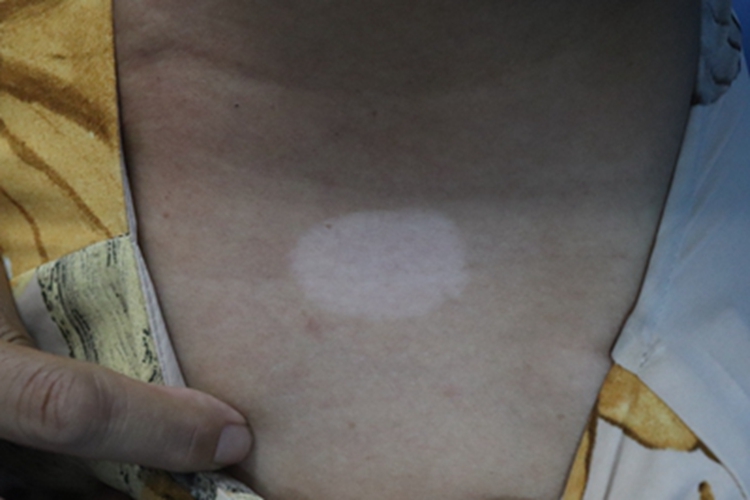 白癜风胸部白斑图 白癜风胸部白斑图