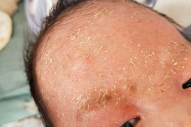 脂溢型婴儿湿疹脱屑图