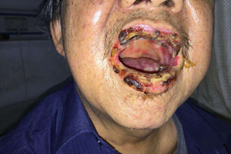 副肿瘤性天疱疮嘴唇糜烂图